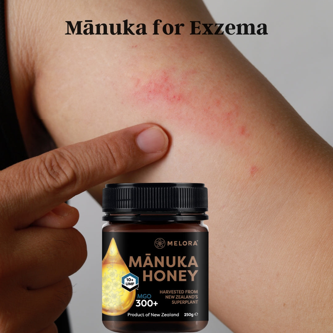 Manuka Honey for Eczema